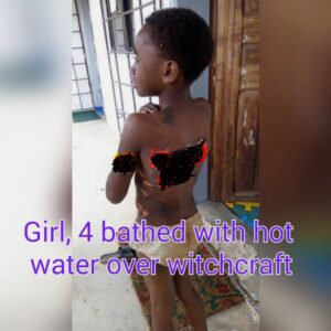 Read more about the article CRARN CALL ON POLICE TO INVESTIGATE CASE OF A CHILD BATHED WITH HOT WATER